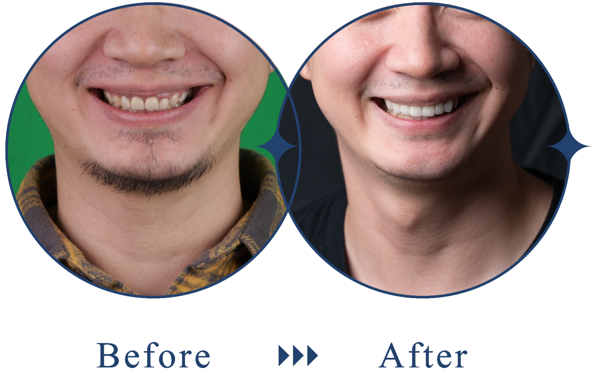 【牙拜醫師：美齒案例】前後對比