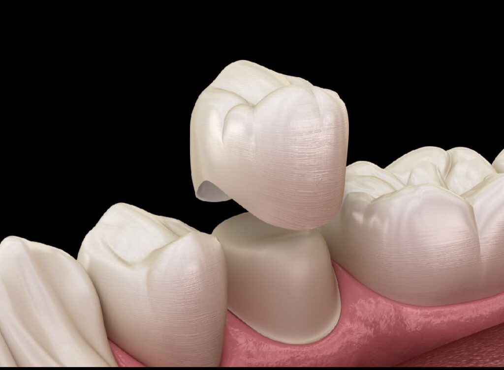 【牙拜醫師：全瓷貼片】牙齒情境示意