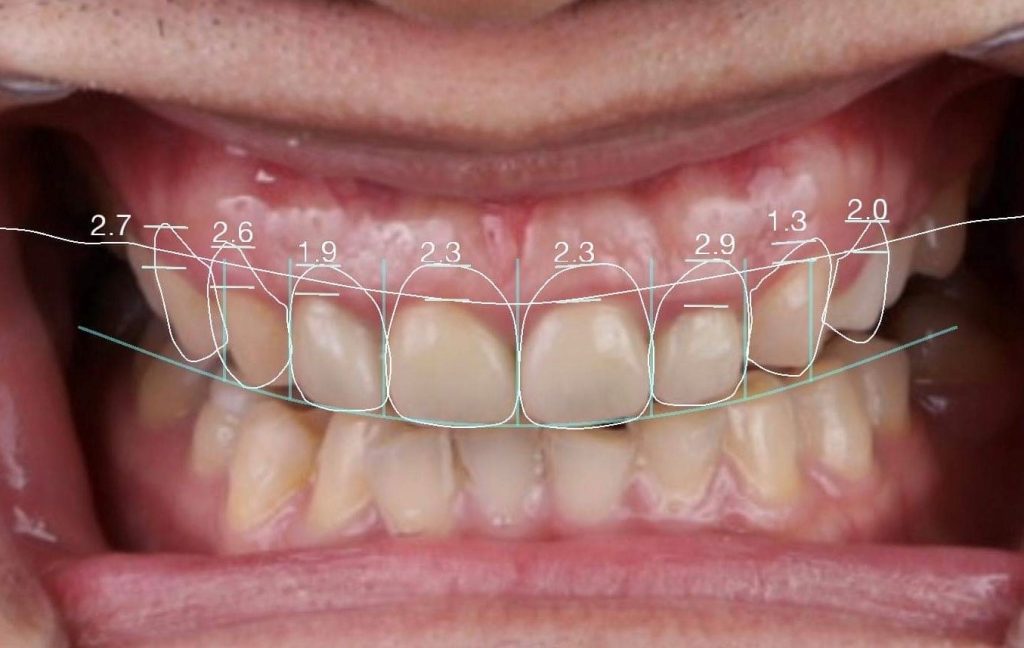 【牙拜醫師：牙齒貼片價格大公開！陶瓷貼片、樹脂貼片優缺點解析】牙齒圖