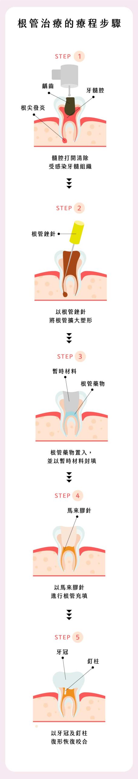 牙拜醫師吳冠儒：根管治療的療程步驟