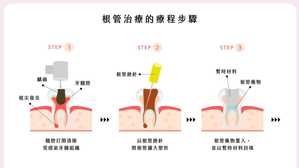 牙拜醫師吳冠儒：根管治療的療程步驟