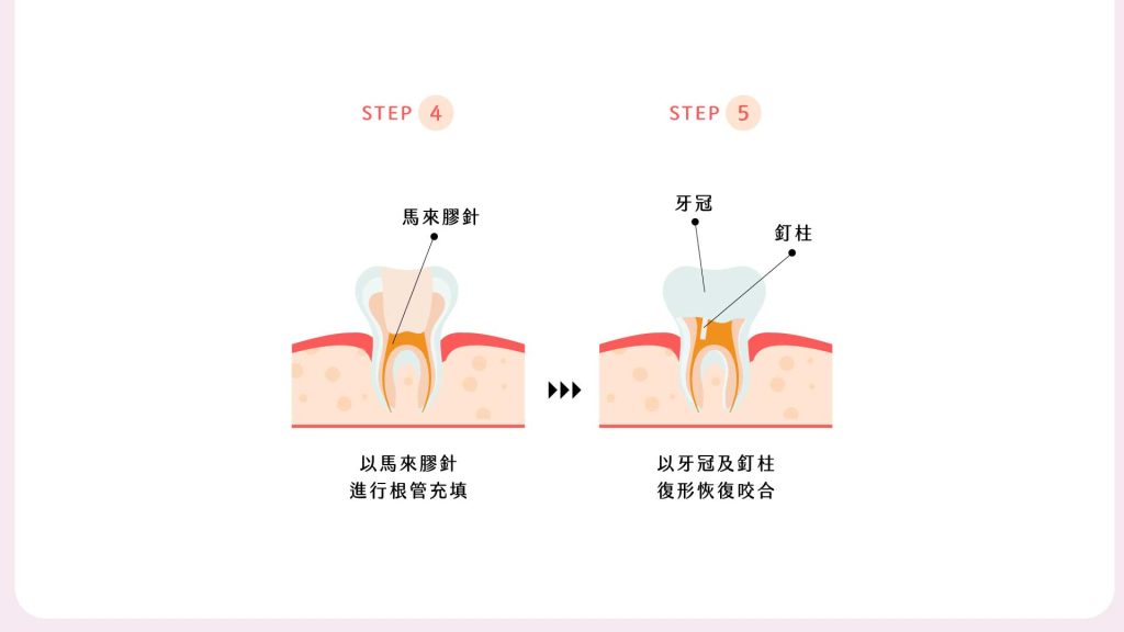 牙拜醫師吳冠儒：根管治療的療程步驟