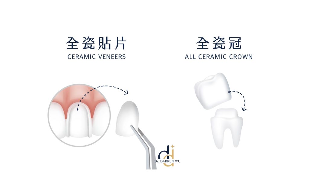 牙拜醫師吳冠儒：全瓷貼片V.S全瓷冠
