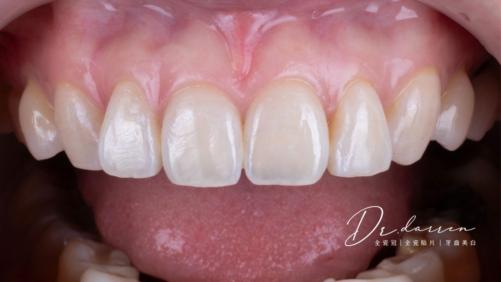 牙拜醫師吳冠儒全瓷冠｜全瓷貼片｜牙齒美白