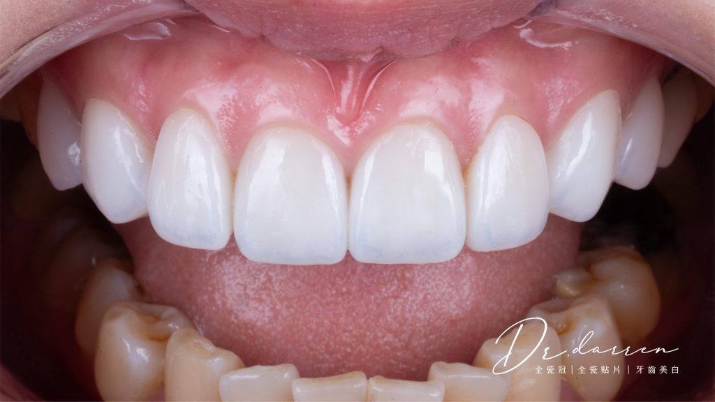牙拜醫師解答你的疑惑：我的牙齒適合做陶瓷貼片嗎?